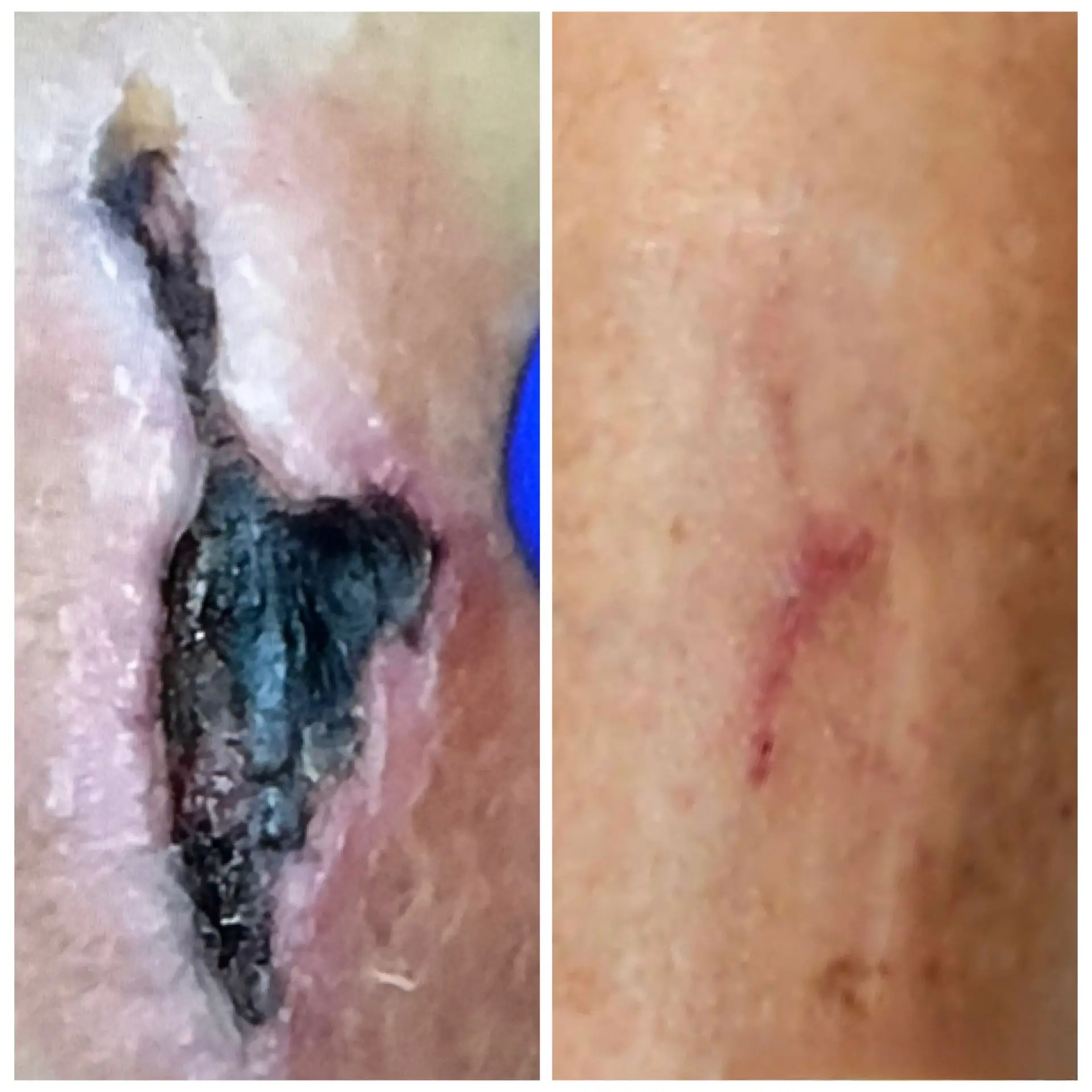 Before and After Leg Wound Care